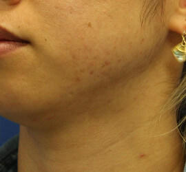 20代女性の小林式ニキビ治療法 After 症例写真