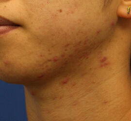20代女性の小林式ニキビ治療法 Before 症例写真