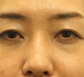 30代女性の目の下の脱脂  After 症例写真