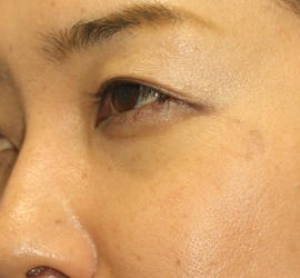 30代女性の目の下の脱脂  After 症例写真