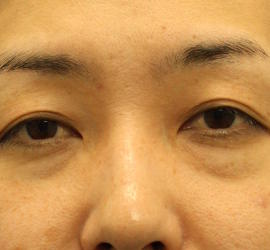 30代女性の目の下の脱脂  Before 症例写真