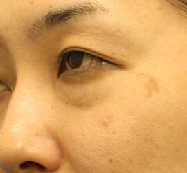 30代女性の目の下の脱脂  Before 症例写真