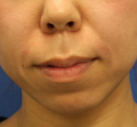 30代女性のシワ・たるみ After 症例写真