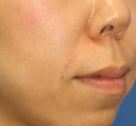30代女性のヒアルロン酸注射  After 症例写真
