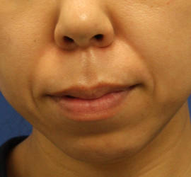 30代女性のシワ・たるみ Before 症例写真