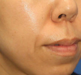 30代女性のヒアルロン酸注射  Before 症例写真