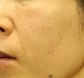 40代女性のシワ・たるみ After 症例写真