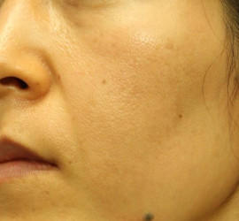 40代女性のシワ・たるみ Before 症例写真