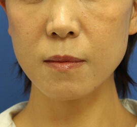 40代女性のシワ・たるみ After 症例写真