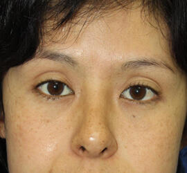 30代女性の3Dリポアイリフト After 症例写真