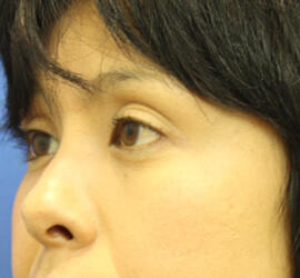 30代女性の3Dリポアイリフト  After 症例写真