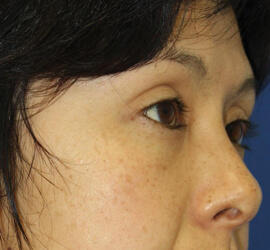 30代女性の3Dリポアイリフト  After 症例写真