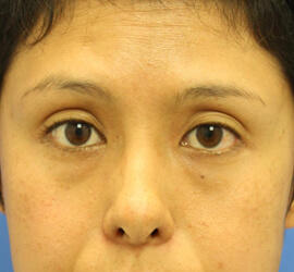 30代女性の3Dリポアイリフト Before 症例写真