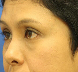 30代女性の3Dリポアイリフト  Before 症例写真