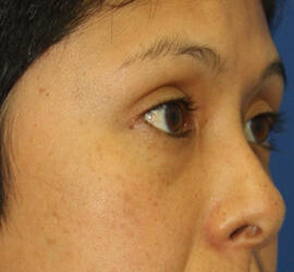 30代女性の3Dリポアイリフト  Before 症例写真