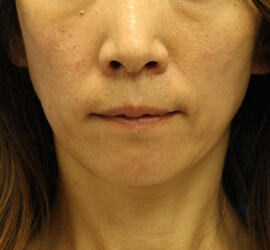 40代女性の After 症例写真