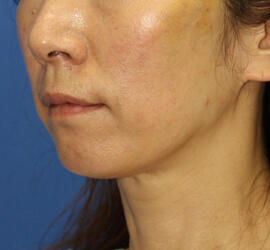 40代女性の After 症例写真
