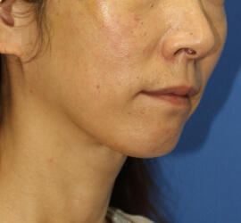 40代女性のシワ・たるみ After 症例写真