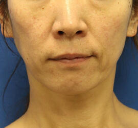 40代女性の Before 症例写真