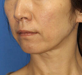 40代女性の Before 症例写真