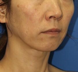 40代女性のシワ・たるみ Before 症例写真