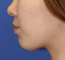 20代女性のメーラーファット除去 After 症例写真