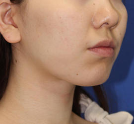 20代女性のメーラーファット除去 After 症例写真