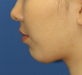 20代女性のメーラーファット除去 Before 症例写真