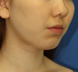 20代女性のメーラーファット除去 Before 症例写真