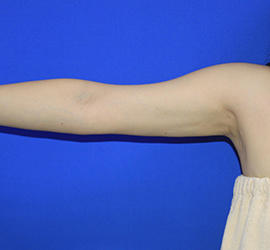 30代女性の脂肪吸引 After 症例写真