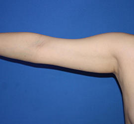 30代女性の脂肪吸引 Before 症例写真