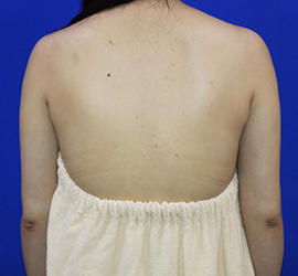 30代女性の脂肪吸引 After 症例写真