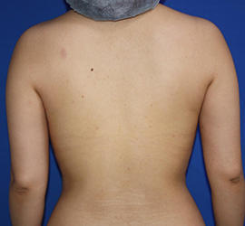 30代女性の脂肪吸引 Before 症例写真