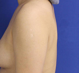 30代女性の脂肪吸引 Before 症例写真