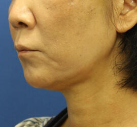 50代女性の After 症例写真