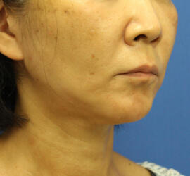 50代女性のシワ・たるみ After 症例写真