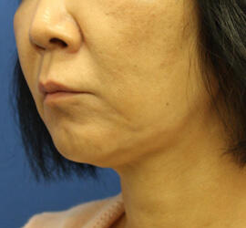 50代女性の Before 症例写真