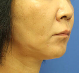 50代女性のシワ・たるみ Before 症例写真