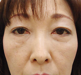 50代女性の下まぶたのたるみ取り After 症例写真