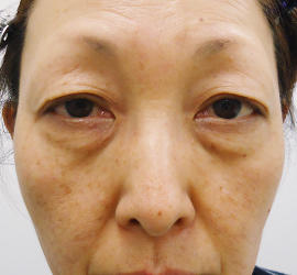 50代女性の下まぶたのたるみ取り Before 症例写真