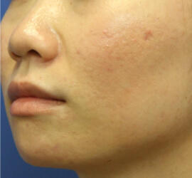 20代女性の小林式ニキビ治療法 After 症例写真