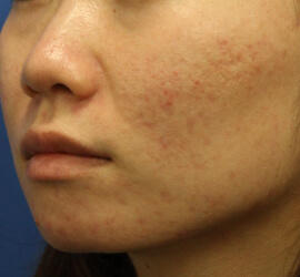 20代女性の小林式ニキビ治療法 Before 症例写真