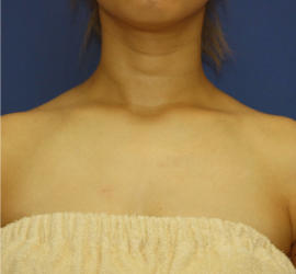 30代女性のその他 After 症例写真