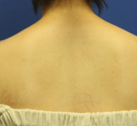 30代女性のボトックス（美肩・肩こり解消） Before 症例写真