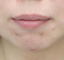 30代女性の小林式ニキビ治療法 After 症例写真