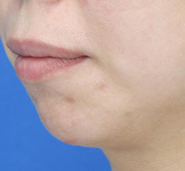 30代女性の小林式ニキビ治療法 After 症例写真