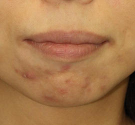 30代女性の小林式ニキビ治療法 Before 症例写真