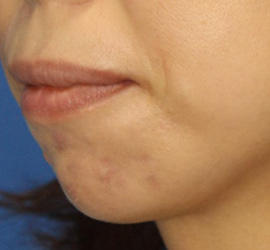 30代女性の小林式ニキビ治療法 Before 症例写真