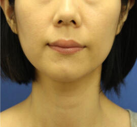 30代女性の小林式ニキビ治療法 After 症例写真