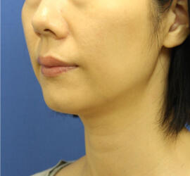 30代女性の小林式ニキビ治療法 After 症例写真